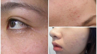 Công thức trị mụn ẩn nhanh và hiệu quả nhất cho bạn làn da láng mịn tươi tắn