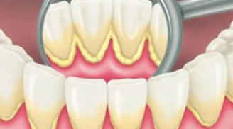 1 quả chanh lấy sạch toàn bộ cao răng mà không cần đi nha sỹ