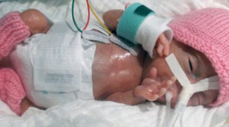 Sự sống sót kỳ diệu của bé sơ sinh nhỏ nhất thế giới, nặng 220g với kích thước chỉ bằng 2 bàn tay