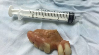 Nuốt cả hàm răng giả vào thực quản