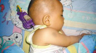 Bé 11 tháng bị đồ chơi cắm vào não, phản ứng của người mẹ khiến bác sĩ tấm tắc