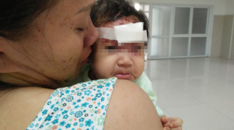 Thương xót: Bé gái 2 tháng tuổi bị khỉ cào rách mặt