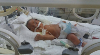Mổ thai 28 tuần do mẹ bị tai nạn giao thông: Cháu bé đã có phản xạ đầu tiên