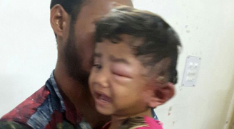 Sốc: Bác sĩ gắp 80 ấu trùng làm tổ trong tai bé gái