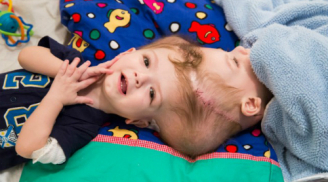 Kỳ diệu: Ca mổ dài 27 giờ tách rời đôi song sinh dính liền đầu