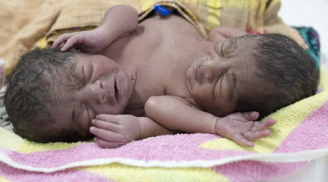 Cặp song sinh dính liền bị bỏ rơi trong bệnh viện