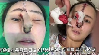 'Sốc' với khuôn mặt dị dạng của cô gái Hàn vì thẩm mỹ hỏng