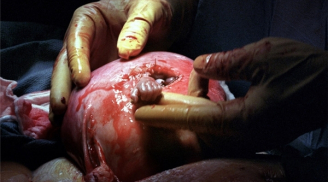 Hình ảnh ngày ấy - bây giờ của thai nhi nắm chặt ngón tay bác sĩ khi đang phẫu thuật giờ ra sao?