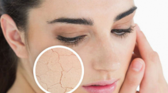 Những cách chữa da mặt khô nẻ mùa đông hiệu quả ai cũng cần biết