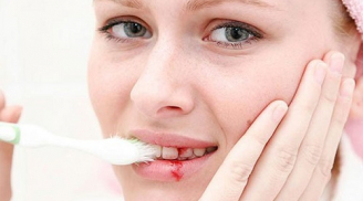 Nếu bị chảy máu chân răng là bạn đang đối mặt với căn bệnh hết sức nguy hiểm này