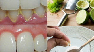 Bí quyết loại bỏ cao răng, mảng bám trong vòng 5 phút siêu hiệu quả ngay tại nhà