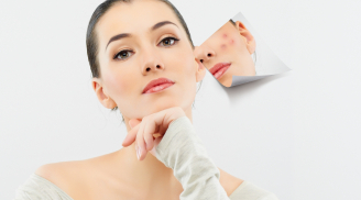 Hướng dẫn cách trị mụn cấp tốc đón Giáng sinh