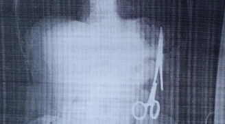 Bộ Y tế yêu cầu xác minh vụ quên chiếc kéo 15 cm trong bụng bệnh nhân 18 năm