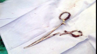 Chiếc kéo 15 cm 'bỏ quên' trong bụng bệnh nhân 18 năm được phẫu thuật lấy ra