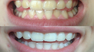 4 cách làm trắng răng cấp tốc siêu hiệu quả trong vòng 2 phút