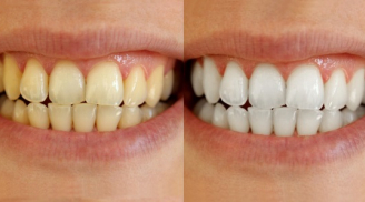 3 cách siêu đơn giản làm trắng răng hiệu quả ngay tại nhà