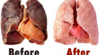 Dù hút thuốc lá lâu năm dùng cách này cũng thải được độc tố trong phổi