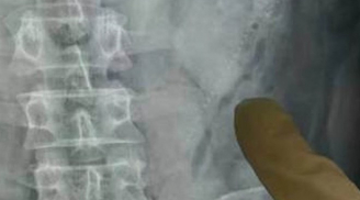 Suýt chết vì nhét 2 con lươn vào hậu môn khi say xỉn