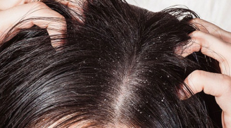 Top 5 cách trị gàu, rụng tóc cực rẻ cực hiệu quả chỉ sau 3 ngày sử dụng