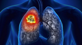 Biểu hiện ung thư phổi giai đoạn đầu nhiều người mắc mà chủ quan không biết