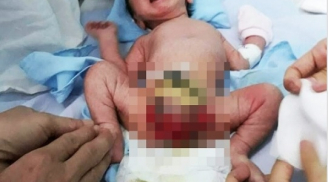 Hi hữu: Cháu bé ở Bình Định bị lộ bàng quang, dị dạng bộ phận sinh dục ngay từ lúc lọt lòng mẹ