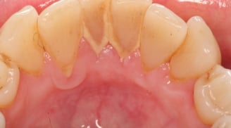 Không cần đi nha sỹ lấy cao răng tốn kém, chỉ cần bạn biết sử dụng những nguyên liệu có sẵn trong bếp này