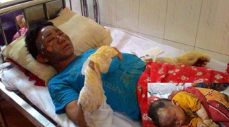 Nổ khí gas, 10 người trong một gia đình ở Lào Cai bị bỏng nặng