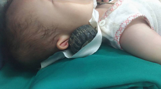 Bé gái 11 tháng tuổi may mắn thoát ch.ết sau khi bị trục sắt đâm sâu vào đầu