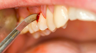 Dấu hiệu ở răng cảnh báo bạn đã mắc ung thư hãy khám ngay kẻo cứu không kịp