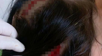Kinh hoàng bé gái 6 tuổi bị chó cắn, phải khâu hơn 30 mũi