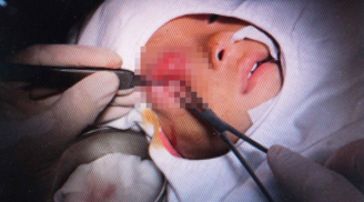 Mẹ chủ quan không điều trị đầy đủ viêm xoang ở mũi cho con, bé 16 tháng tuổi suýt mù vì biến chứng