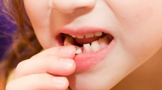 Trẻ mấy tuổi thì thay răng sữa?