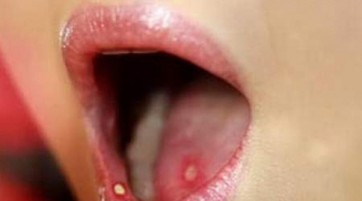 3 dấu hiệu vùng đầu cổ phải nghĩ ngay đến ung thư lưỡi đừng nhầm với nhiệt miệng
