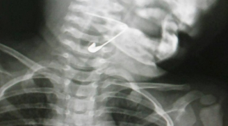 Điểm tin mới ngày 25/8: Siêu âm X-quang, bác sĩ hết hồn thấy kim băng xiên ngang thực quản bé gái 18 tháng tuổi
