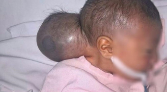Bé gái sơ sinh '2 đầu' bị bỏ rơi được các bác sỹ cưu mang và cứu sống thành công
