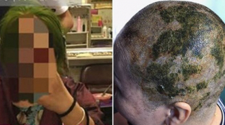 Nhuộm tóc 4 lần trong 7 tiếng để có màu xanh lá, người phụ nữ bị sốc phản vệ và phải cạo trọc đầu