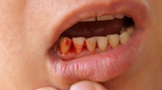 Thấy chảy máu chân răng đừng nghĩ viêm lợi hãy tới bệnh viện ngay lập tức
