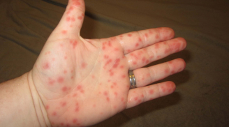 Những biểu hiện của bệnh sốt xuất huyết?
