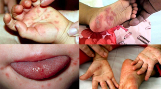 Cảnh báo: Bệnh tay chân miệng đang bùng phát ở Đắk Lắk