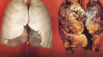 Ăn thực phẩm này mọi độc tố trong phổi sẽ được thải hết, phổi đen tới mấy cũng trắng trở lại