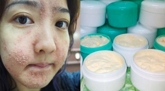 Dưỡng trắng bằng kem trộn, chị em bị 'lột sạch' da mặt, mất hàng trăm triệu điều trị nhưng chỉ phục hồi được 30-40%