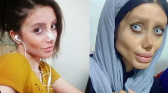 Kinh hoàng cô gái bị biến dạng khuôn mặt khi 'dao kéo' hàng chục lần để giống Angelina Jolie