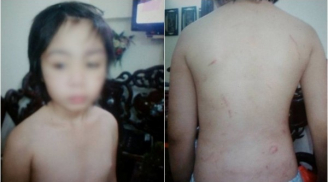 SỐC: Bé trai 10 tuổi ở Hà Nội nghi bị bố và mẹ kế bạo hành gãy xương sườn, rạn sọ não