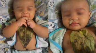 Bé gái 6 tháng tuổi ngực bị bỏng sâu, chảy dịch nghiêm trọng vì đắp lá trầu không chữa chứng khò khè