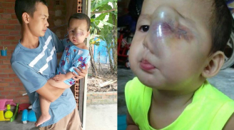Đau xót bé trai 18 tháng tuổi bị căn bệnh quái ác, mắt trái bị nổ tung và nguy cơ hỏng nốt mắt phải