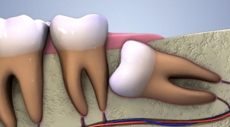 5 biến chứng nguy hiểm khi mọc răng khôn bạn cần biết
