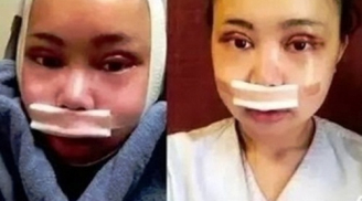 Cô gái Việt đau đớn trải qua 7 ca phẫu thuật để giống Địch Lệ Nhiệt Ba