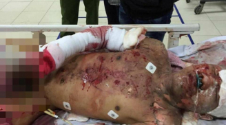 Vụ nổ lớn ở Nghệ An: Một nam thanh niên bị thương nặng