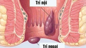 Dân văn phòng cần làm điều này chẳng lo mắc trĩ nếu bị rồi áp dụng cách sau sẽ khỏi nhanh hơn dùng thuốc