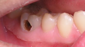 Các bệnh về răng - lợi thường gặp nhất